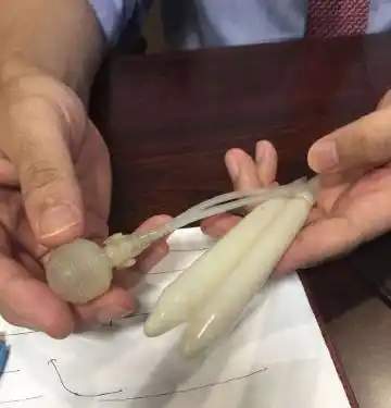 丁丁假体植入术又称支撑体植入术,是将假体或支撑体植入丁丁海绵体腔