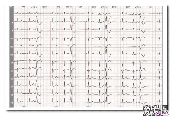 室性早搏三联律心电图
