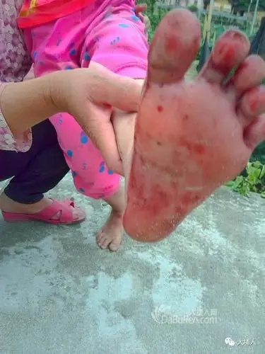 大埔一小学内施工5岁小孩和村民遭铁钉扎脚