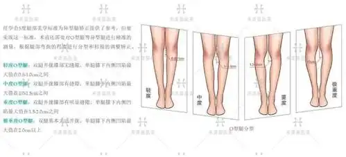 国内最好的自体脂肪矫正腿型医生关几梦:o型腿能矫正吗?