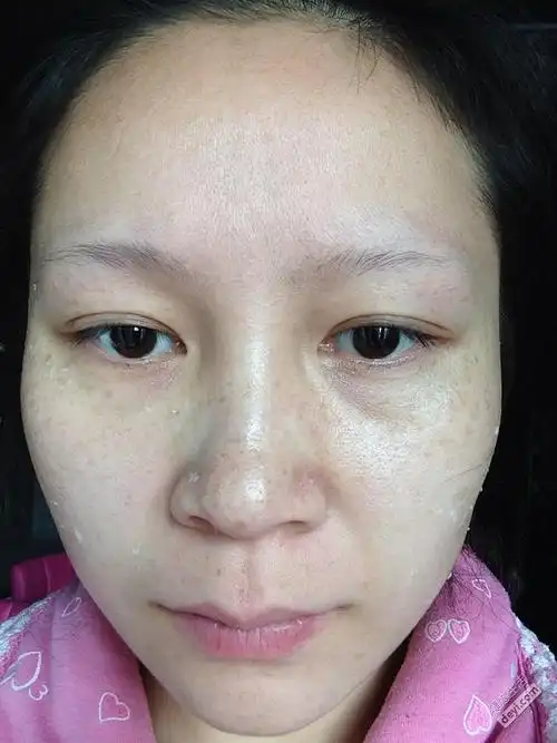 69 脸上的斑点终于去掉了,我要做个干净的女人   从小lz就有晒斑