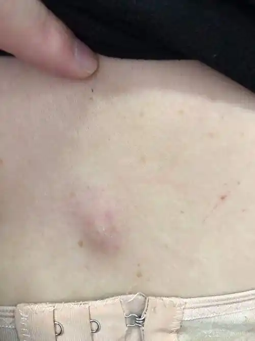 背部皮脂腺囊肿