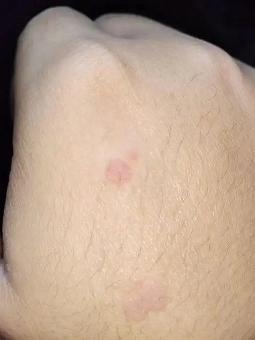 手背上这个东西是扁平疣吗我该怎么办