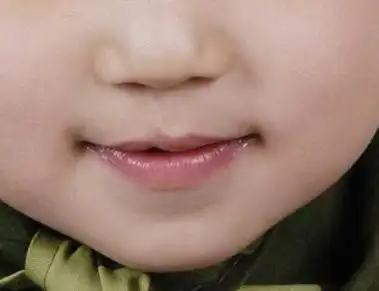 隐性腭裂也是一种上唇的畸形,由于畸形的存在,上唇肌肉连续性或者附着