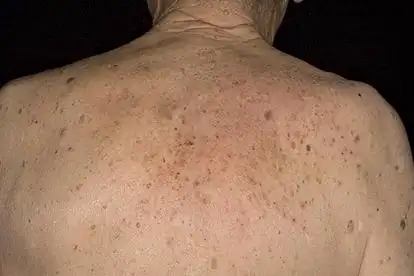 之后可形成红色斑片,上面覆盖有鳞屑,并伴有皮肤干燥,脱屑,瘙痒等