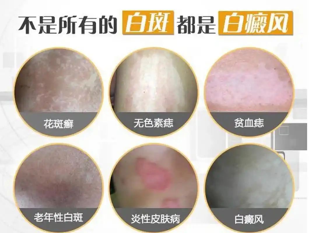 白癜风病发初期,白斑一般是斑点状,是没有大片的白斑片出现的,一般