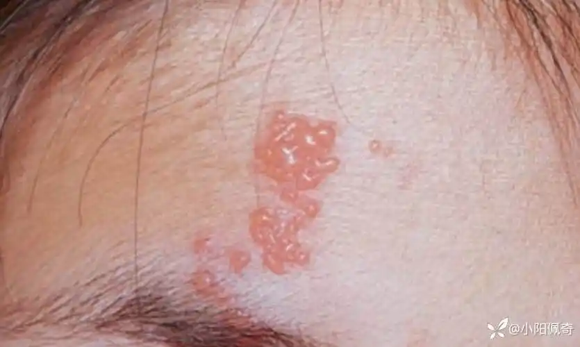 皮肤黏膜单纯疱疹