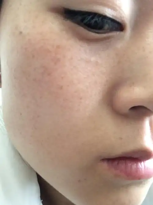 脸上的斑越来越多