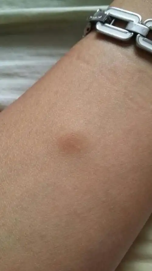 胳膊上长了一个包,发黑青色,一按就疼,长了两年了,想知道