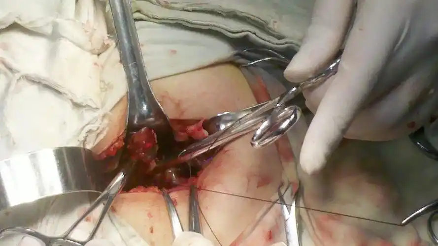 昨晚做的一例阑尾炎手术(附图片) - 好大夫在线