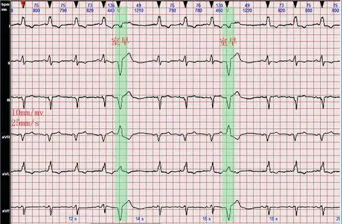 心电图病例分析完全性左束支阻滞