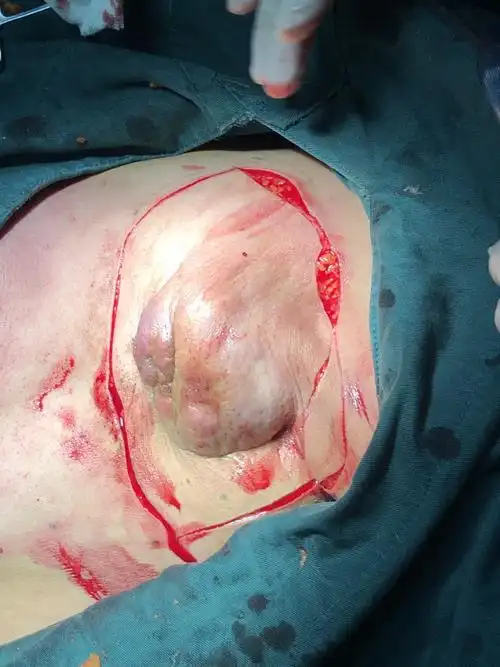 个案分享 重医附一院内分泌乳腺外科—背阔肌带蒂皮瓣转移修复乳腺癌