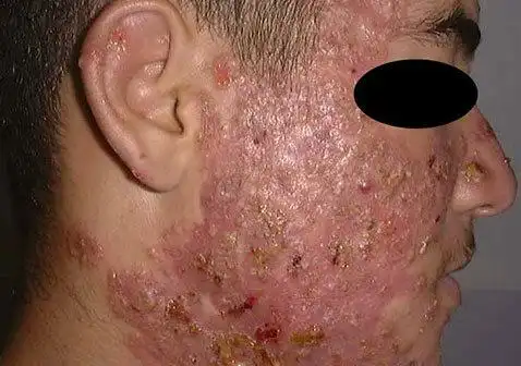 脸上脓包型痤疮痘痘图片