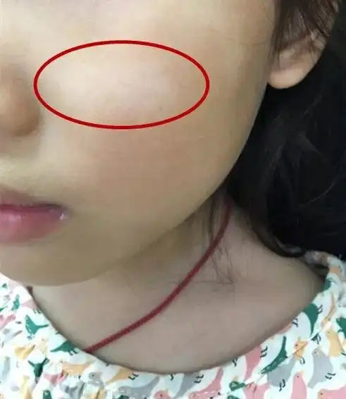 通常我们见到的孩子脸上的白斑,是白色糠疹,并非家长以为的那些.