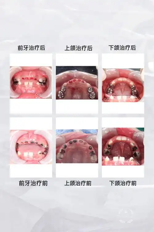 儿童全麻下牙齿治疗_龋齿_龋齿治疗方式 - 好大夫在线