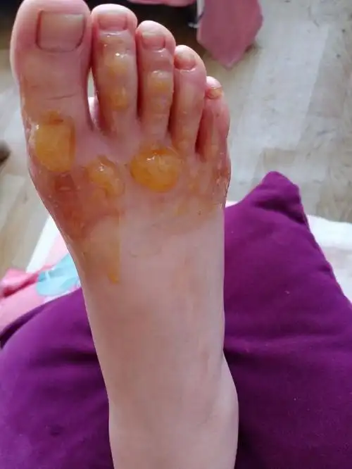 我的千金今天烫伤了脚01妈妈很心疼.