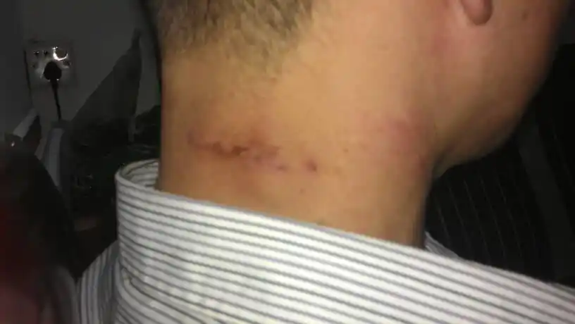 脂肪瘤术后还有肿块!