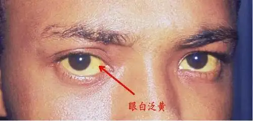 眼白泛黄