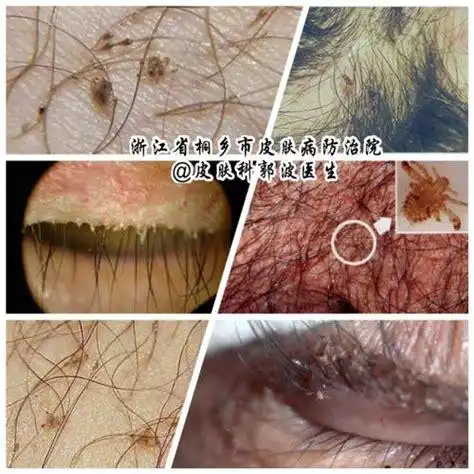 长了阴虱虫内裤的图片_有阴虱的内裤是怎样的2022已更新(今日/资讯)-