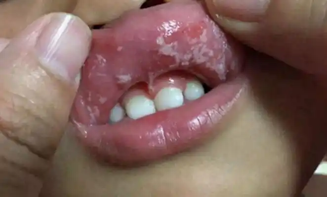 口腔粘膜白斑图片62