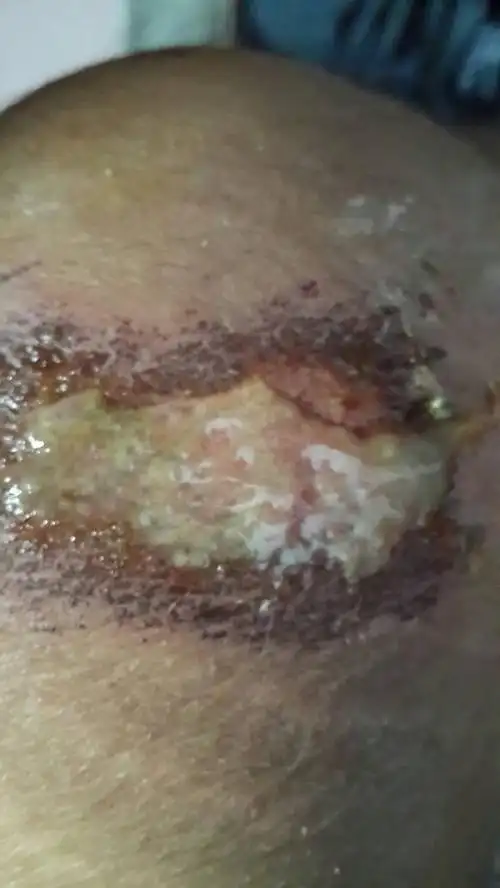 我的膝盖昨天摔伤了,也去医院处理了,现在发现伤口流出一些淡黄色的