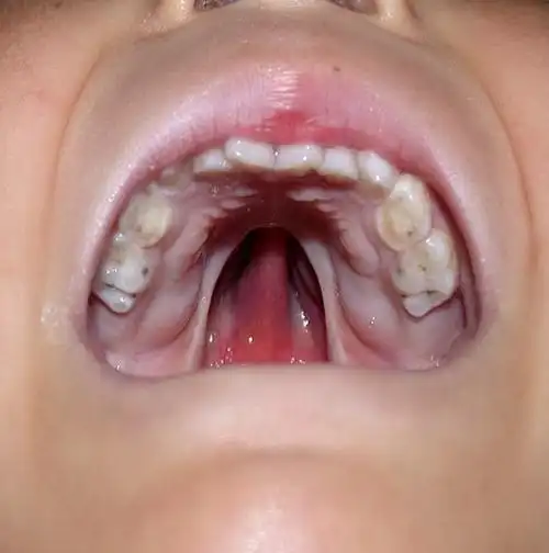 唇腭裂是什么?主要是什么原因导致的?