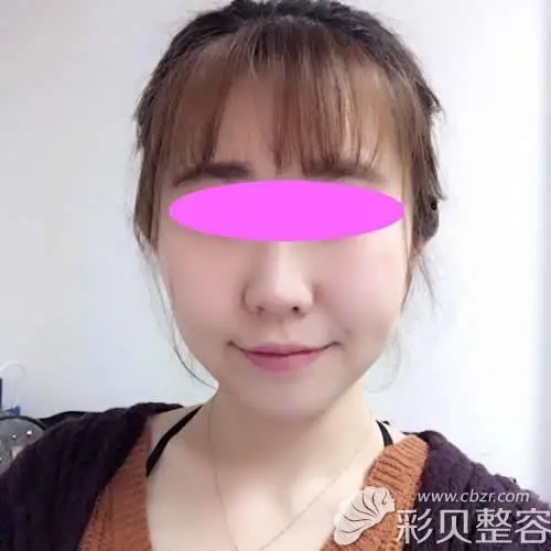 南京施尔美整形杨东旭做的瘦脸除皱瘦脸案例注射后20天效果