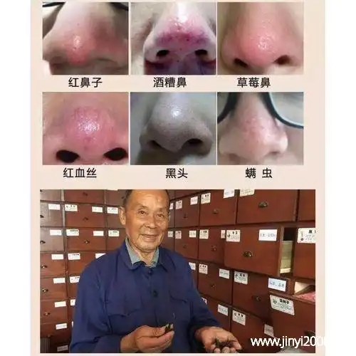 酒糟鼻能彻底治好吗荸荠治疗酒糟鼻怎么用