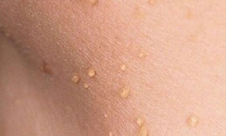 不要把丝状疣当做尖锐湿疣,给自己造成困扰.