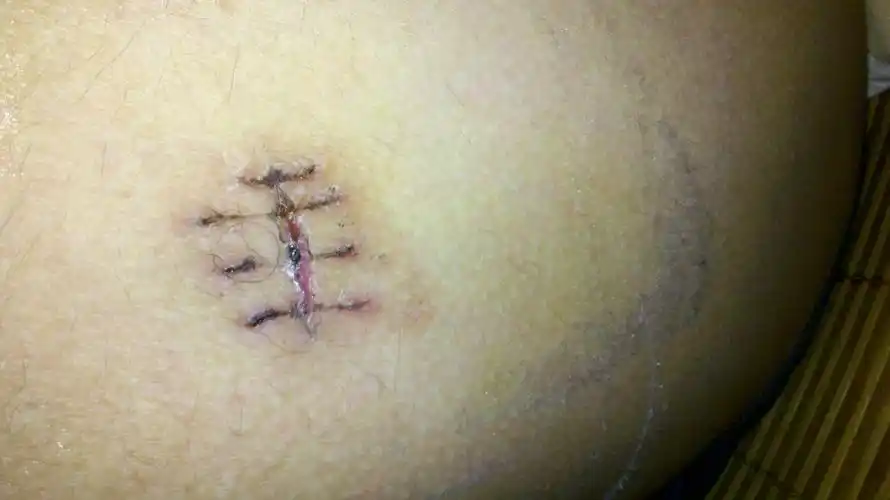 大腿左外侧长了一个大指姆般大小的粉瘤,手术后大概有20天,拆线后大概