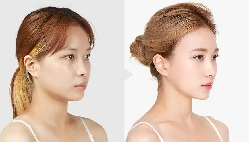 大眼睛,挺鼻子,俏下巴,最能够让五官变立体的整形方法