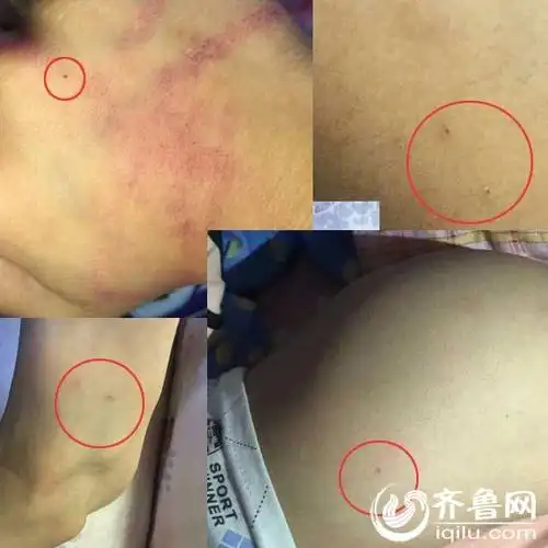 临沂孩子称被幼儿园老师用针扎校方称与己无关