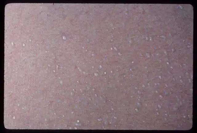 可分为晶状粟粒疹,又名白痱(晶痱),汗管破裂和汗液溢出在角质层内或