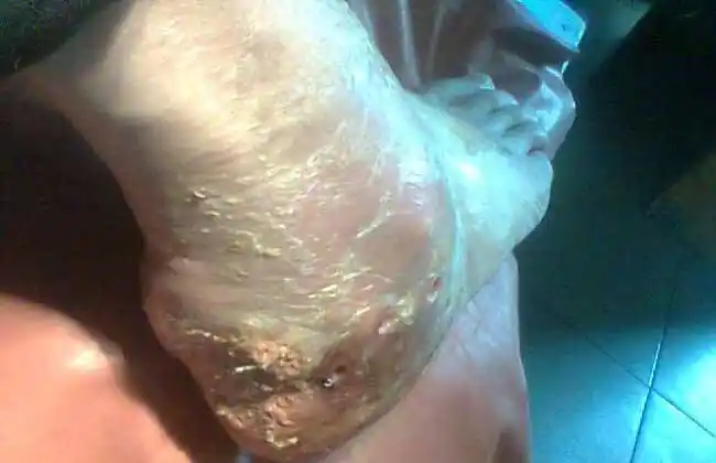 霉菌感染是怎么回事?