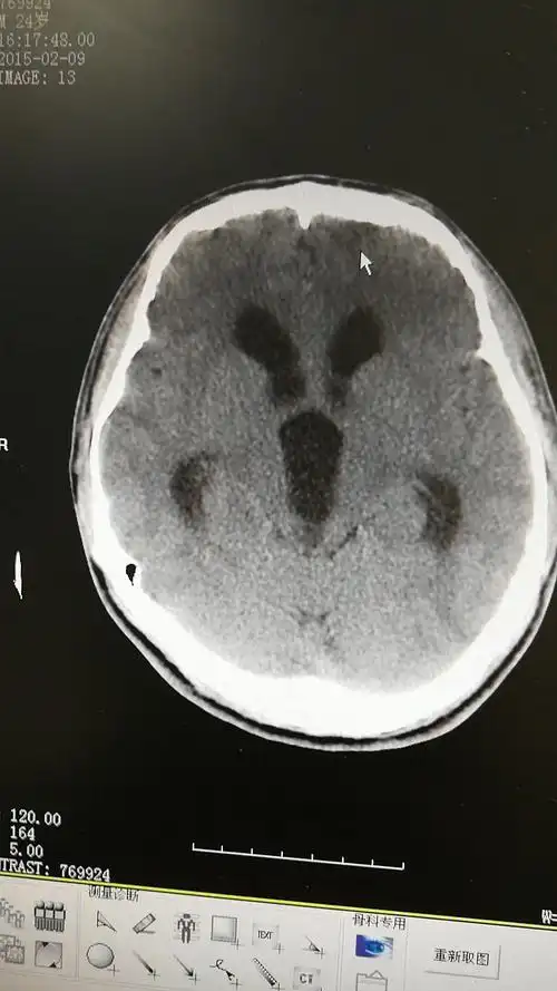 手术后可以明显改善症状,效果明显.脑积水ct显示:侧脑室,三脑室扩大