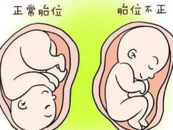 胎位正不正不用去医院,教你这两种方法自己判断不求人