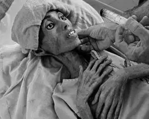 图片素材-非洲肺结核患者