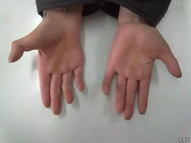 双手麻木萎缩两年求助