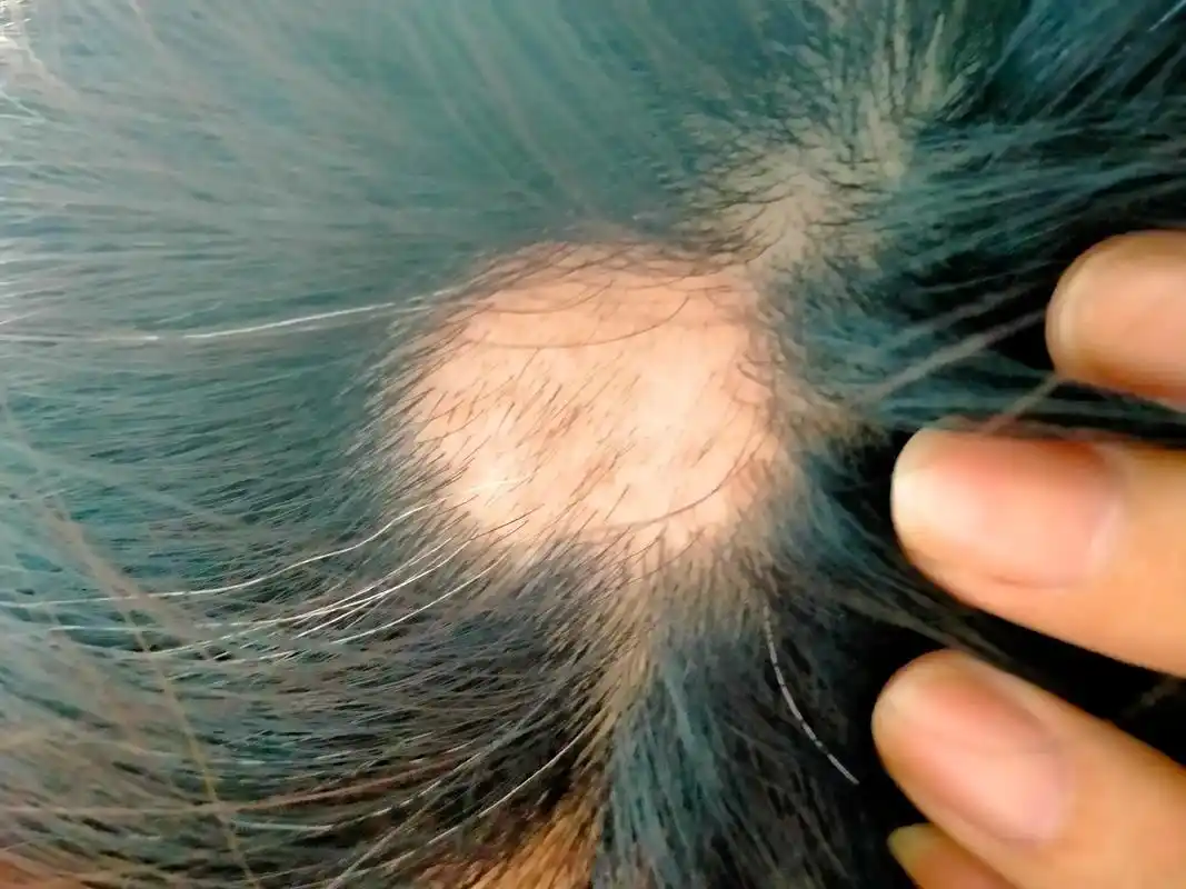 夏秋真菌皮肤病高发     甲癣    汗斑  - 抖音