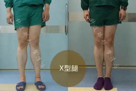 x型腿在医学上称为膝外翻,俗称八字步.
