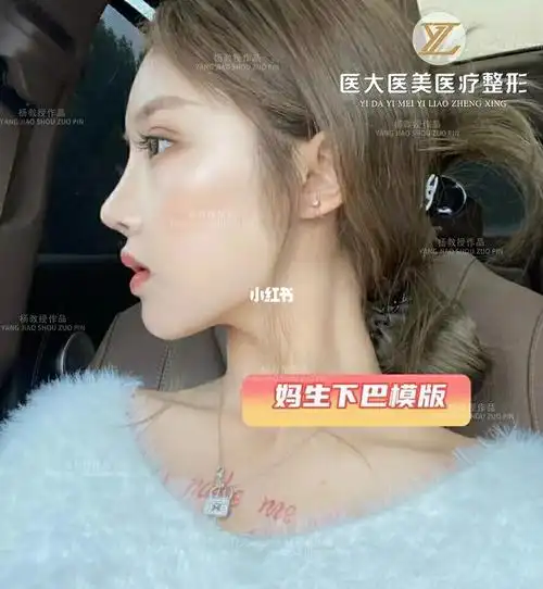 假体下巴案例_美妆_医美_整容_美妆_医美整形