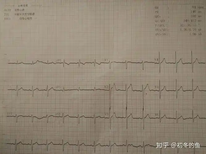 心电图左偏有图