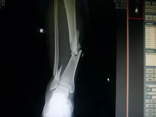 双小腿骨折