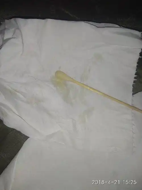 白带糊状 无异味 下面痒 以前有过宫颈糜烂二度 做了普利刀手术后