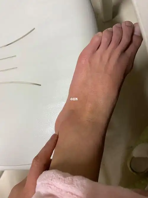 居然崴到脚了,呜呜呜,明天还要考体育,希望不要肿了#脚崴了