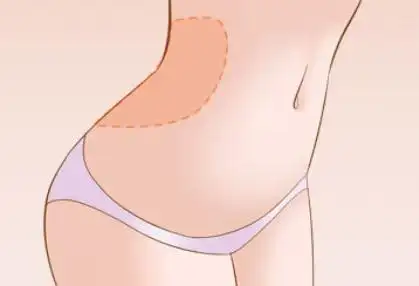 韩国做腰腹环吸包含哪些部位?是怎么收费的?