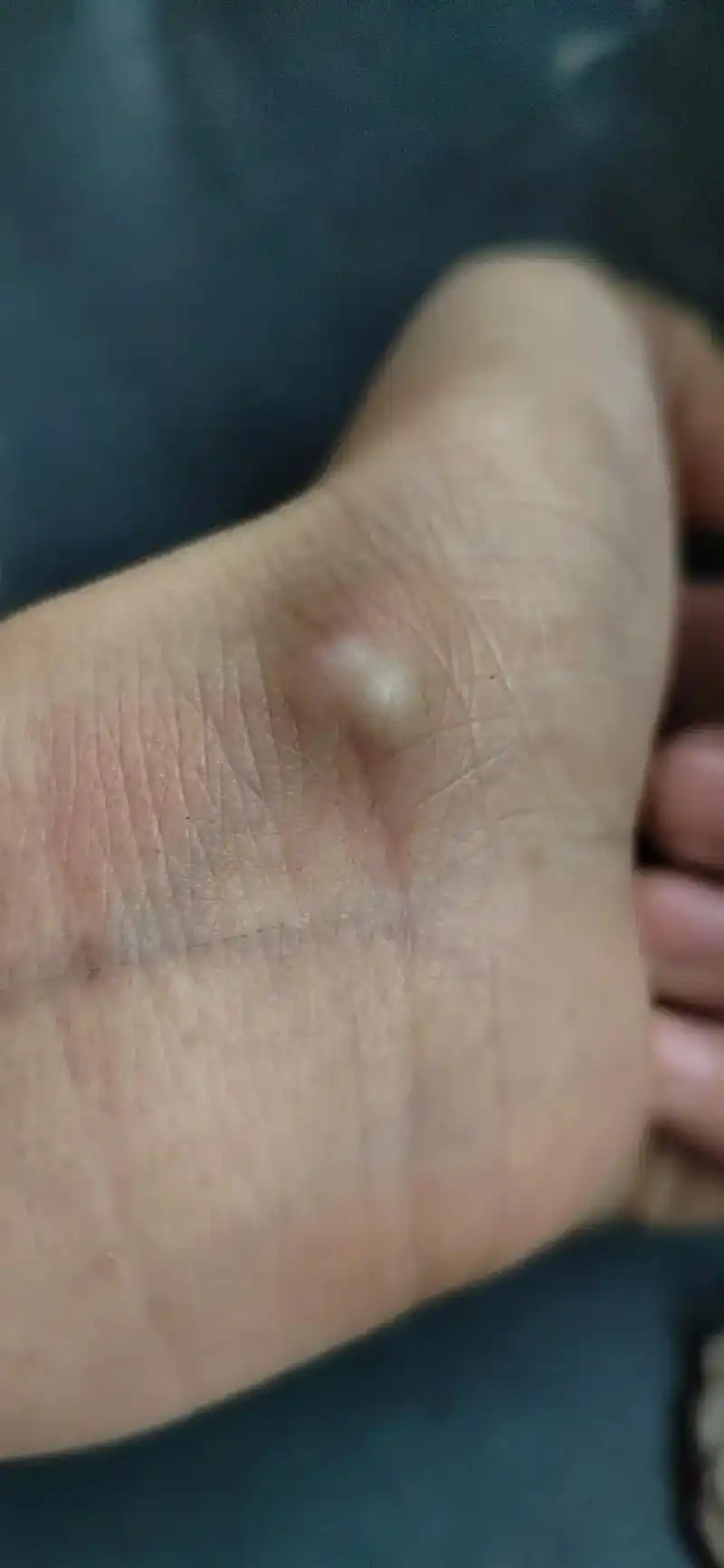 长了二年多的脂肪瘤,用了一盒不到的神奇艾侠悬灸宝,他.他 - 抖音