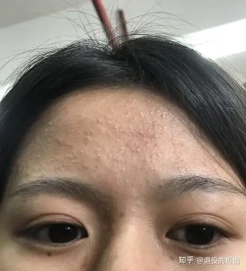 脸上长了好多闭口粉刺!求姐妹们出出招 怎么去除? - 知乎
