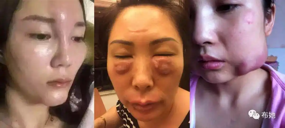 不良微整伤害的重灾区,及修复案例