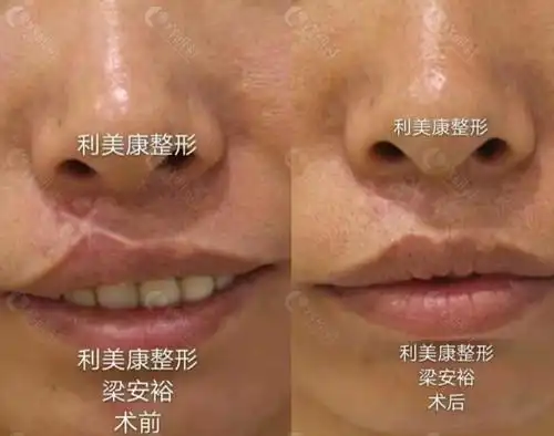 唇腭裂修复手术前后对比照